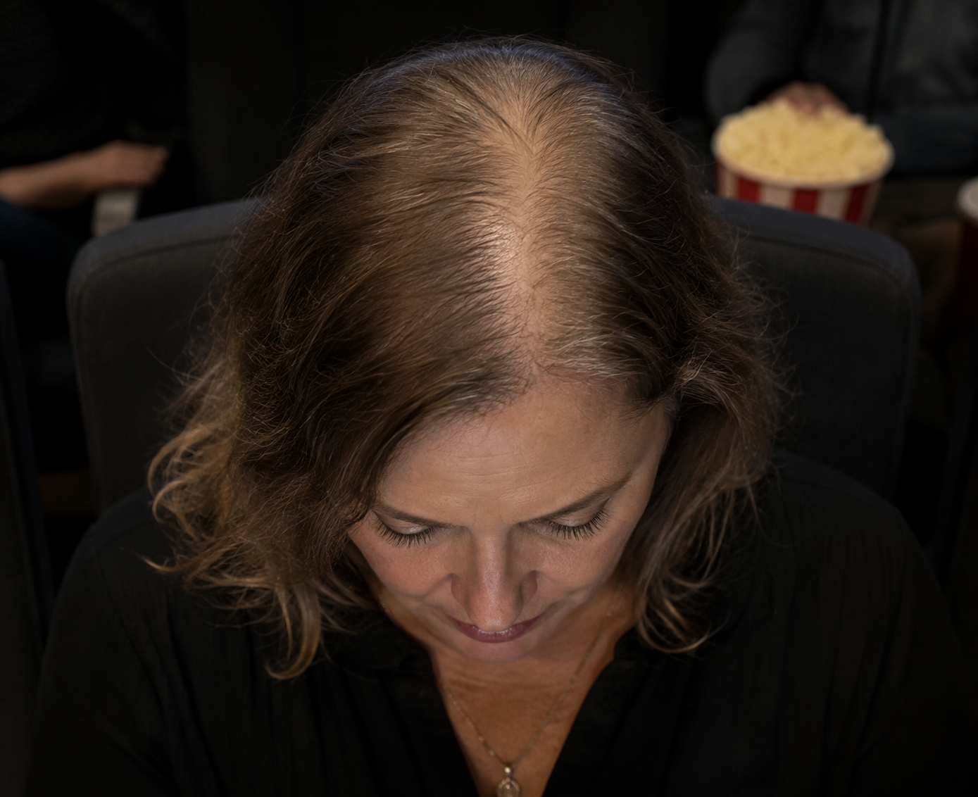 Mulher na menopausa com alopecia androgenética feminina e rarefação capilar na região central do couro cabeludo